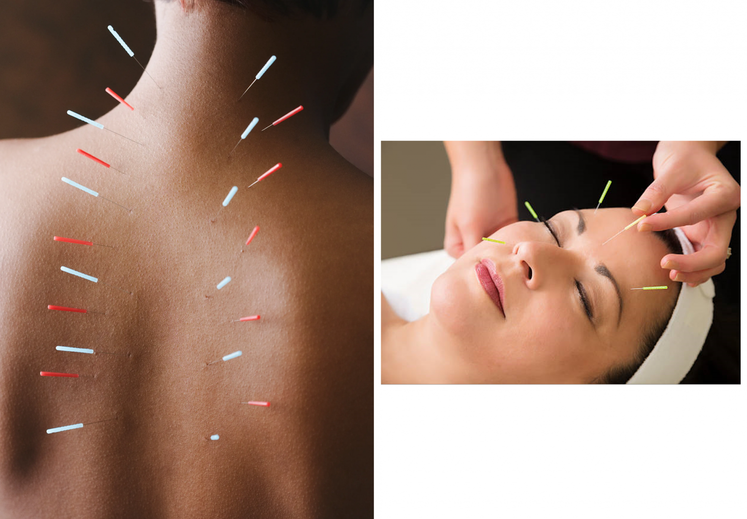 Acupuncture: Ancient energy, modern benefits for health and beauty