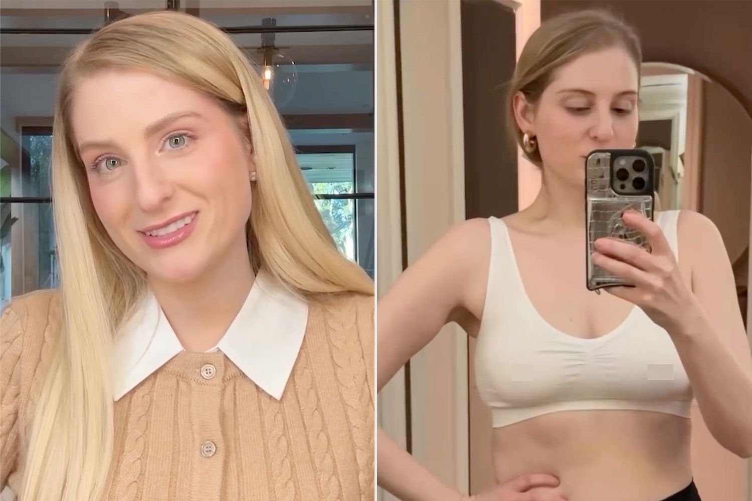 Meghan Trainor Unveils Before-and-After of Boob Job